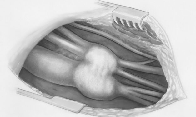 Carotid Sonic Lithotripsy Adoption Grows